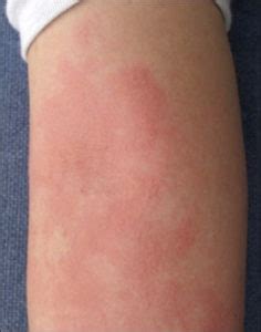 Aquagenic Urticaria - Causes, Diagnosis, Facts and Treatment