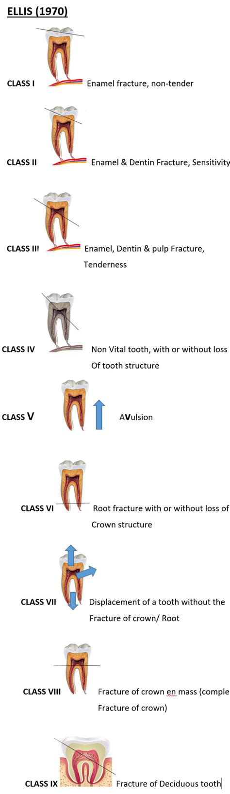 Classification Of Tooth Fracture