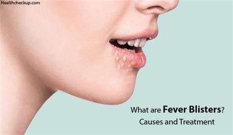 What are Fever Blisters? Causes, Symptoms and Home Remedies