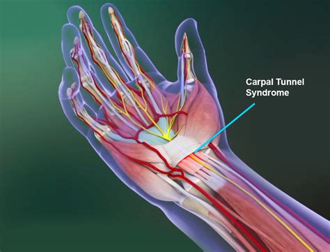 Carpal Tunnel Syndrome Memphis | Wrist Pain Memphis | Hand Surgery Memphis