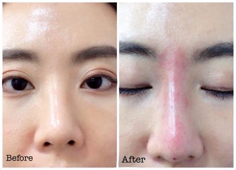 My 30-minute Lunch Time Facelift! [Hiko Nose Threads + Dermalift] – YingVannie