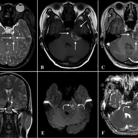 -The preoperative brain MRI. It showed a left cerebellopontine angle... | Download Scientific ...