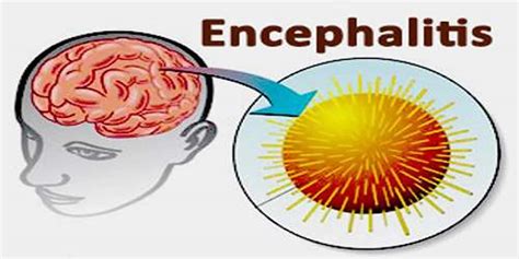 Encephalitis - Causes, Symptoms, Diagnosis, Prognosis & Treatment