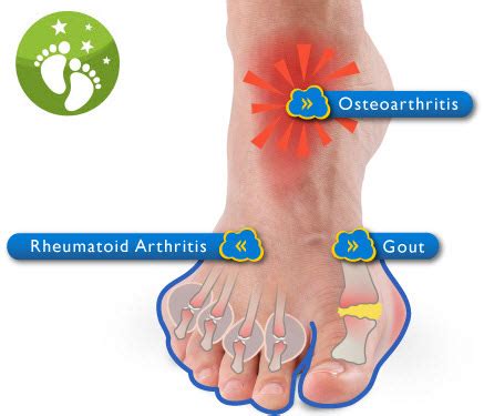 Arthritis - Shelby Twp. Macomb - Foot and Ankle Care