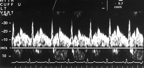 Vertebral Artery Doppler Waveform Changes Indicating Subclavian Steal Physiology | AJR