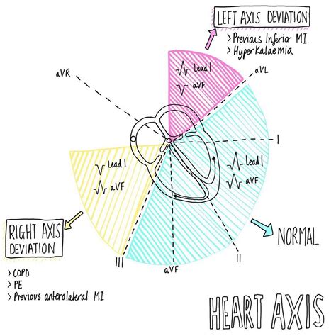 Axis Deviation - Common causes #exams #science #notes #illustration #heart #medic #medschool # ...