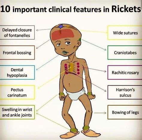 Ricket in children - Sign & Symptoms, Cause & Treatment – Trishla Ortho