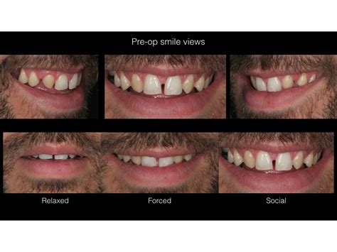 Implant placement in a patient with congenitally missing upper lateral ...