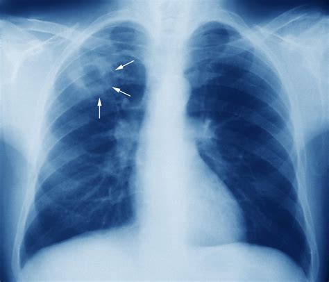 Epidemiology of tuberculosis – Dutable