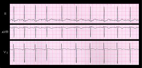 Wandering Atrial Pacemaker Rhythm Strip