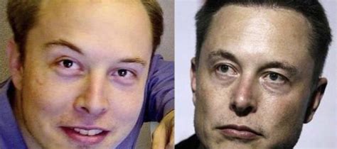 Did Elon Musk Get a Hair Transplant? - İberia Clinic