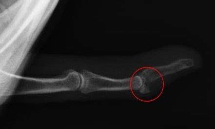 Avulsion Fracture - Rock and Ice