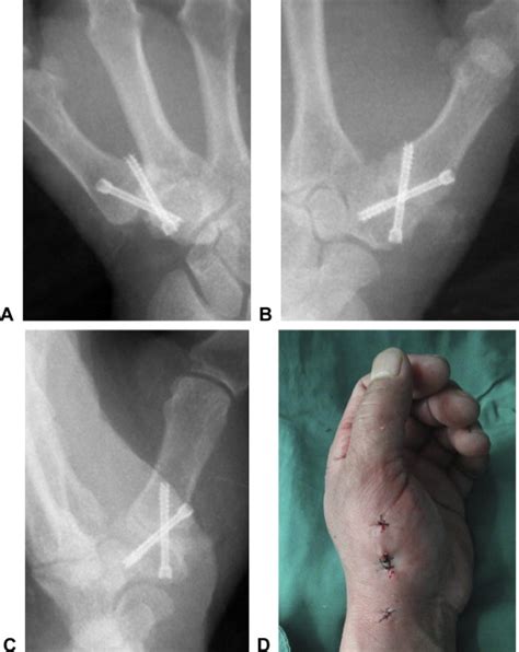 Minimally Invasive Thumb Carpometacarpal Joint Arthrodesis With ...