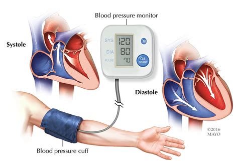 Presión arterial alta (hipertensión) - Diagnosis & treatment - Mayo Clinic