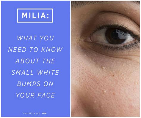 Tiny white bumps on skin what are milia – Artofit