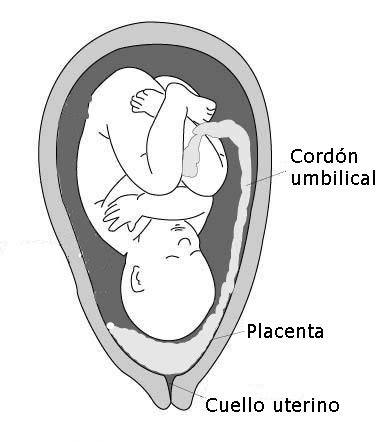 Placenta previa