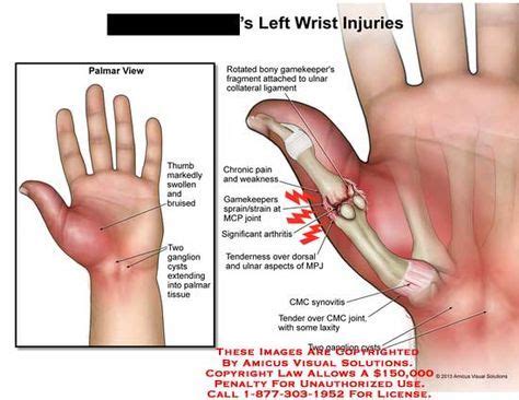 How Long Sprained Thumb To Heal - Margaret Greene Kapsels