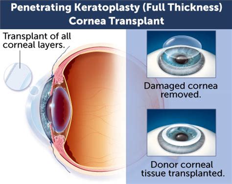 Cornea Transplant Video