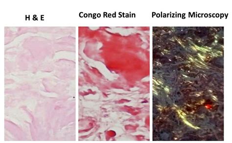 AMYLOIDOSIS: PART 3: Morphology, Diagnosis, Special stains, clinical ...