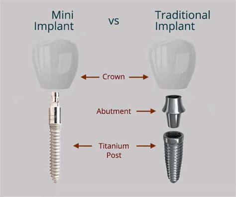 Best Midtown NYC Mini Dental Implants near you | Treating Missing Teeth near Lenox Hill, Turtle ...