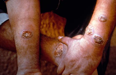 Mucocutaneous Leishmaniasis