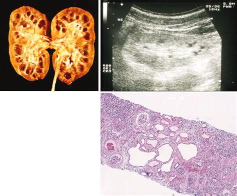 JASN | Mobile | Renal, Cysts, Differentiation