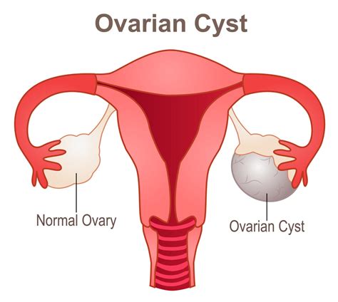 Ovarian Cysts: Types, Symptoms, Diagnosis and Treatment - Ask Dr. Angela