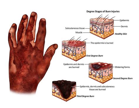 Degree Stages Of Burn Injuries Photograph by Krystal Thompson