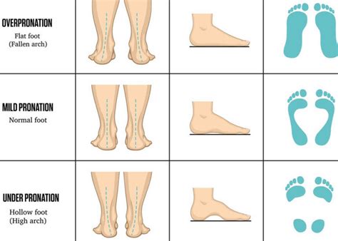 Overpronation, overpronation causes and how to fix overpronation