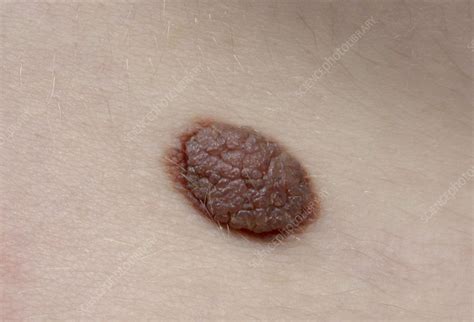 Nevus - Stock Image - C004/0532 - Science Photo Library