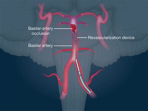 Endovascular Therapy for Basilar-Artery Occlusion | NEJM