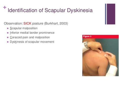 SCAPULAR DYSKINESIS AND ITS RELATION TO SHOULDER PAIN PDF