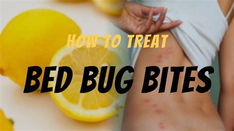 Bed Bug Bite Relief: Effective Ways to Treat Bed Bug Bites - Remedies & Tips - YouTube