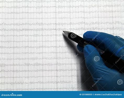 Results of an Electroencephalogram after a Neurophysiological ...