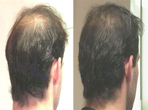 Account Suspended | Hairstyles for thin hair, Thin hair men, Regrow thinning hair