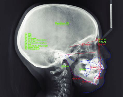 X Ray Skull Anatomy