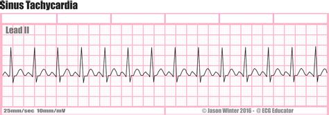 ECG Educator Blog : Six Second ECG Rhythm Strips