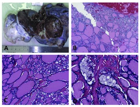 Struma ovarii in a 67-year-old patient: (A) Large ovarian mass with... | Download Scientific Diagram