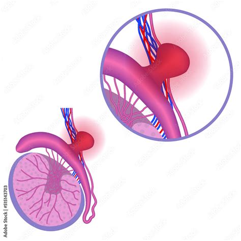 Spermatocele. Epididymal cyst. Anatomy of the male reproductive system. Medical poster. Vector ...