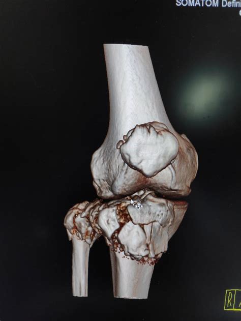 Comminuted Fracture on 74/M MVA : r/Radiology