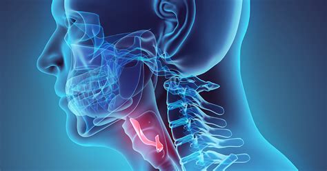 A Definitive Endoscopic Fix for Idiopathic Subglottic Stenosis