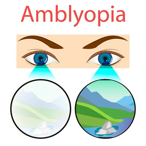 Amblyopia | Eye Patient