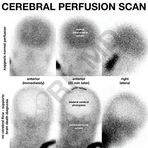 Cerebral Perfusion Scans And Brain Death | RK.MD