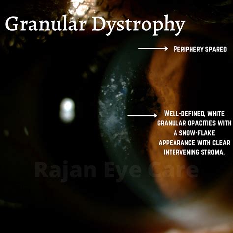 Granular Corneal Dystrophy!