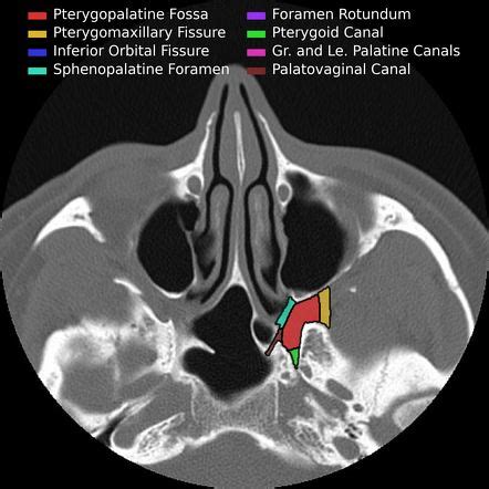 Pterygopalatine fossa (annotated CT) | Radiology Case | Radiopaedia.org ...