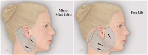 Micro-Mini Facelift Richmond, VA | Cutting Edge Mini Facelift