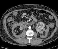 Medical Treatment Pictures-for Better Understanding: Retroperitoneal Fibrosis