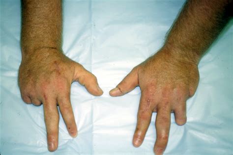 AMPUTATION, FINGER | Hand Surgery Source