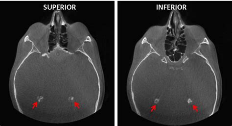 Calcificación de los Plexos Coroideos – Dento Metric | Radiología Dental, Oral y Maxilofacial