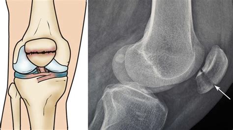 Fracture Patella Broken Knee